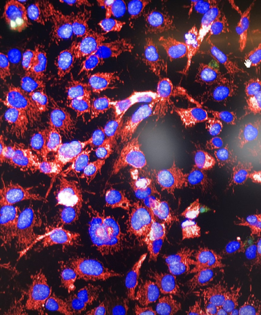 Ενθαρρυντικές για την αντιμετώπιση ανθεκτικών καρκίνων οι νεότερες θεραπείες με ραδιενεργά ισότοπα