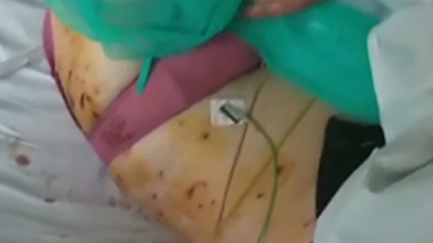 Κεραυνός στην Ακρόπολη- Τραυματίας συγκλονίζει: «Με χτύπησε μία λάμψη, κάηκα...»