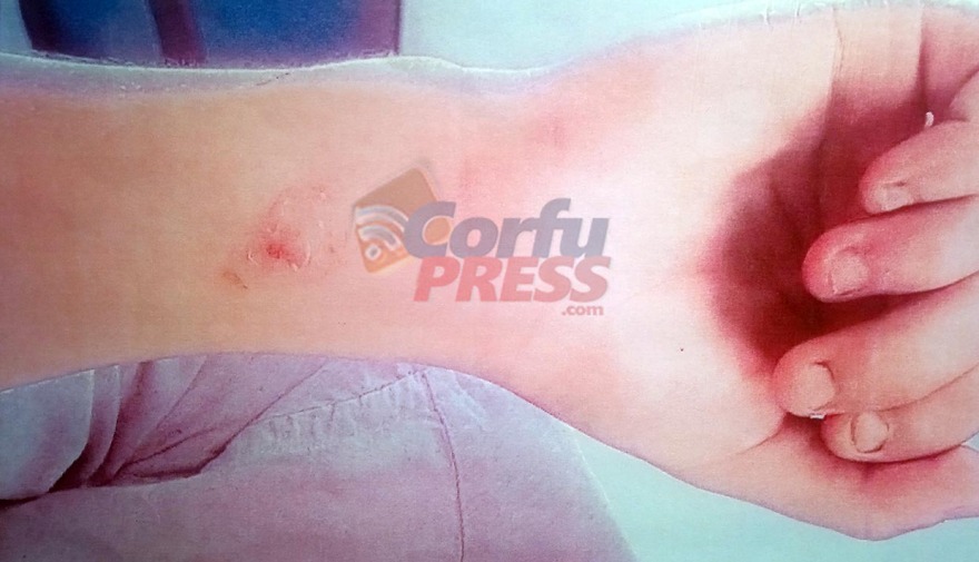 Απίστευτο περιστατικό στην Κέρκυρα: Βασάνιζαν με καυτό λάδι σπουδαστή μαγειρικής σε εστιατόριο 