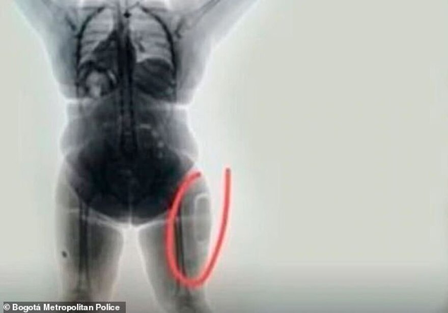 Απίστευτη υπόθεση στην Κολομβία: Έβαλε με εγχείρηση στον μηρό της ένα κιλό υγρής κοκαΐνης!