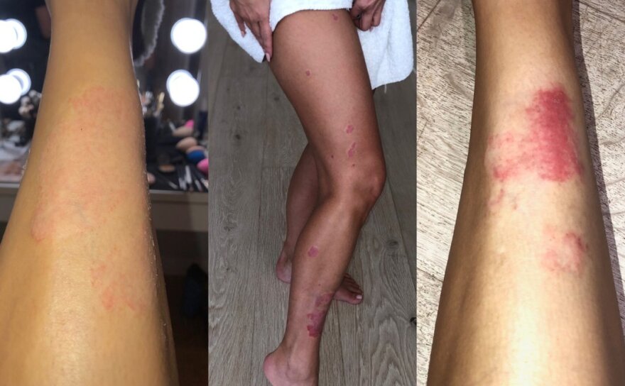 Η Κιμ Καρντάσιαν αφαιρεί το make up και δείχνει τα σημάδια της ψωριασικής αρθρίτιδας πάνω της