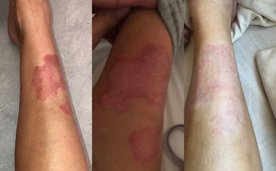 Η Κιμ Καρντάσιαν αφαιρεί το make up και δείχνει τα σημάδια της ψωριασικής αρθρίτιδας πάνω της