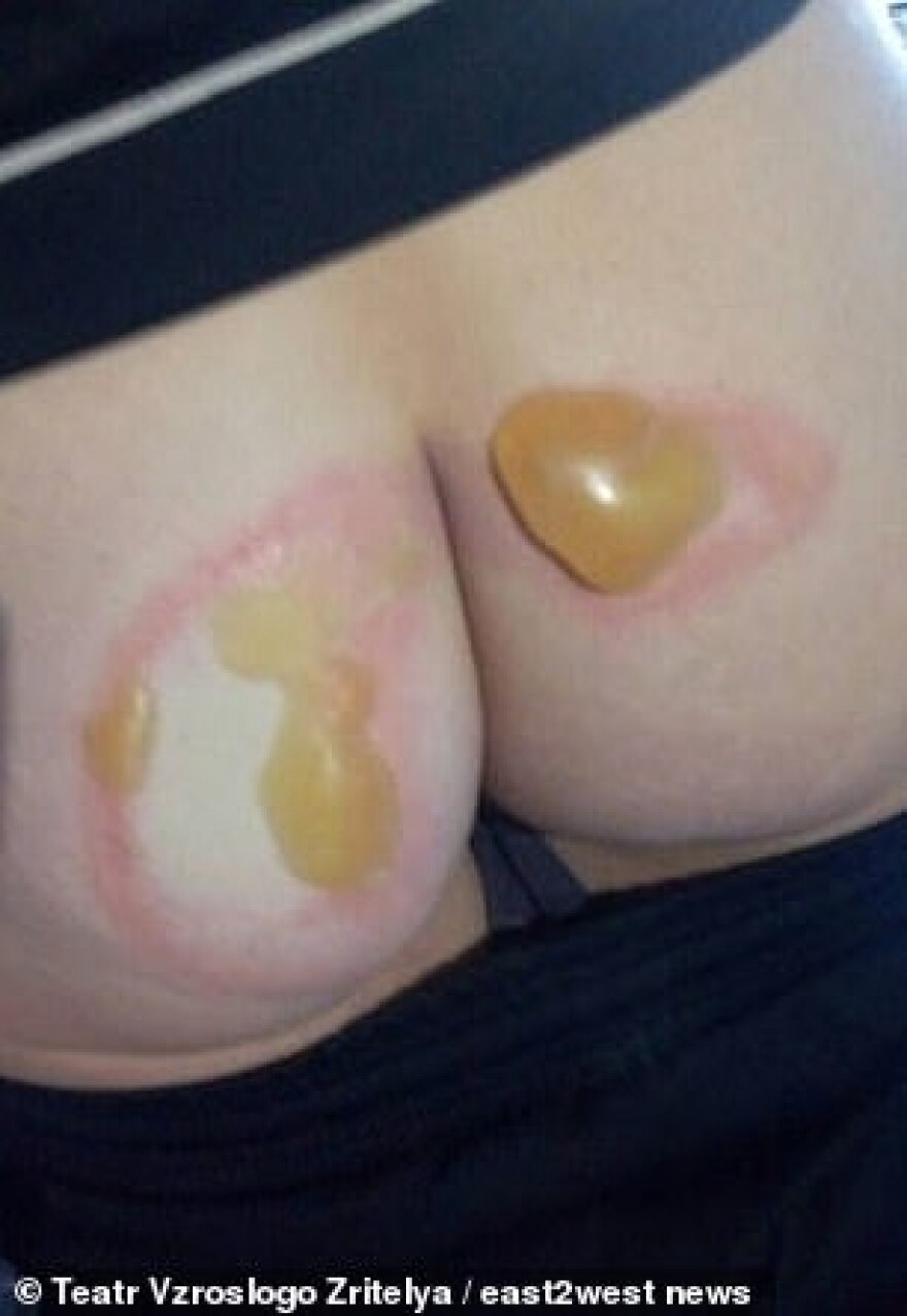 Ρώσοι αστυνομικοί έκαψαν τα οπίσθια υπόπτου για ληστεία