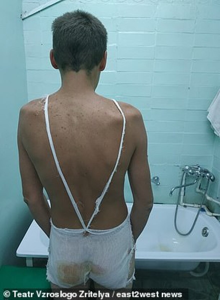 Ρώσοι αστυνομικοί έκαψαν τα οπίσθια υπόπτου για ληστεία