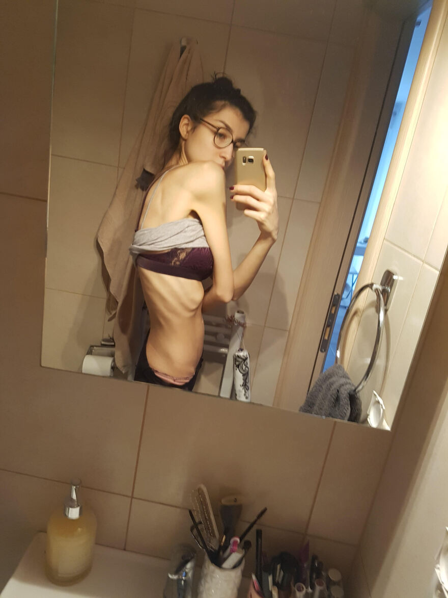 Κατερίνα Βισέρη: Η πρώην παίκτρια του GNTM, ο εφιάλτης της ανορεξίας και η απώλεια των μαλλιών της