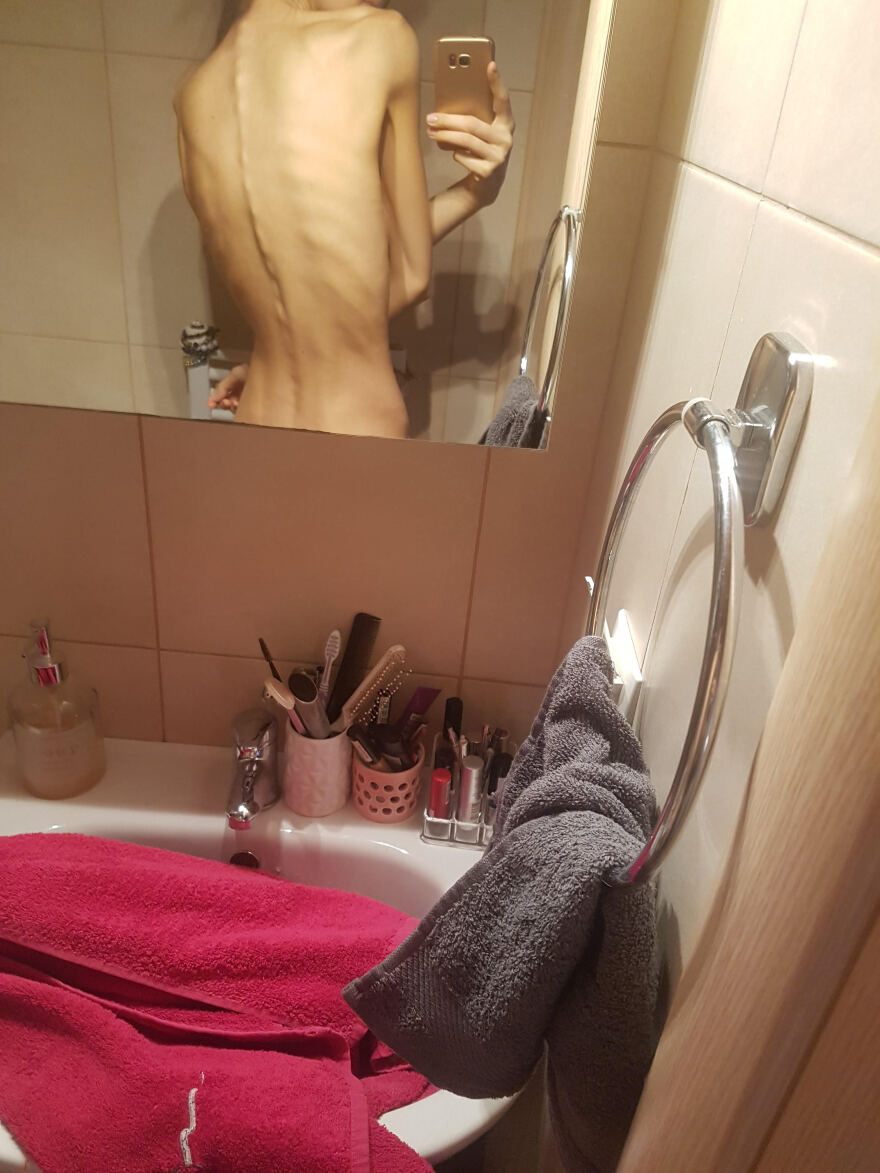 Κατερίνα Βισέρη: Η πρώην παίκτρια του GNTM, ο εφιάλτης της ανορεξίας και η απώλεια των μαλλιών της