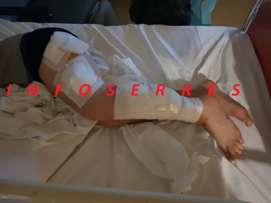 Άγρια επίθεση από σκυλιά σε 9χρονο στις Σέρρες: Δείτε φωτογραφίες με το τραυματισμένο παιδί 