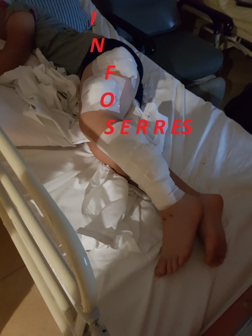 Άγρια επίθεση από σκυλιά σε 9χρονο στις Σέρρες: Δείτε φωτογραφίες με το τραυματισμένο παιδί 