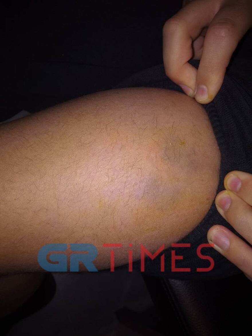 Σκυλιά δάγκωσαν και τραυμάτισαν μαθητές στη Θεσσαλονίκη