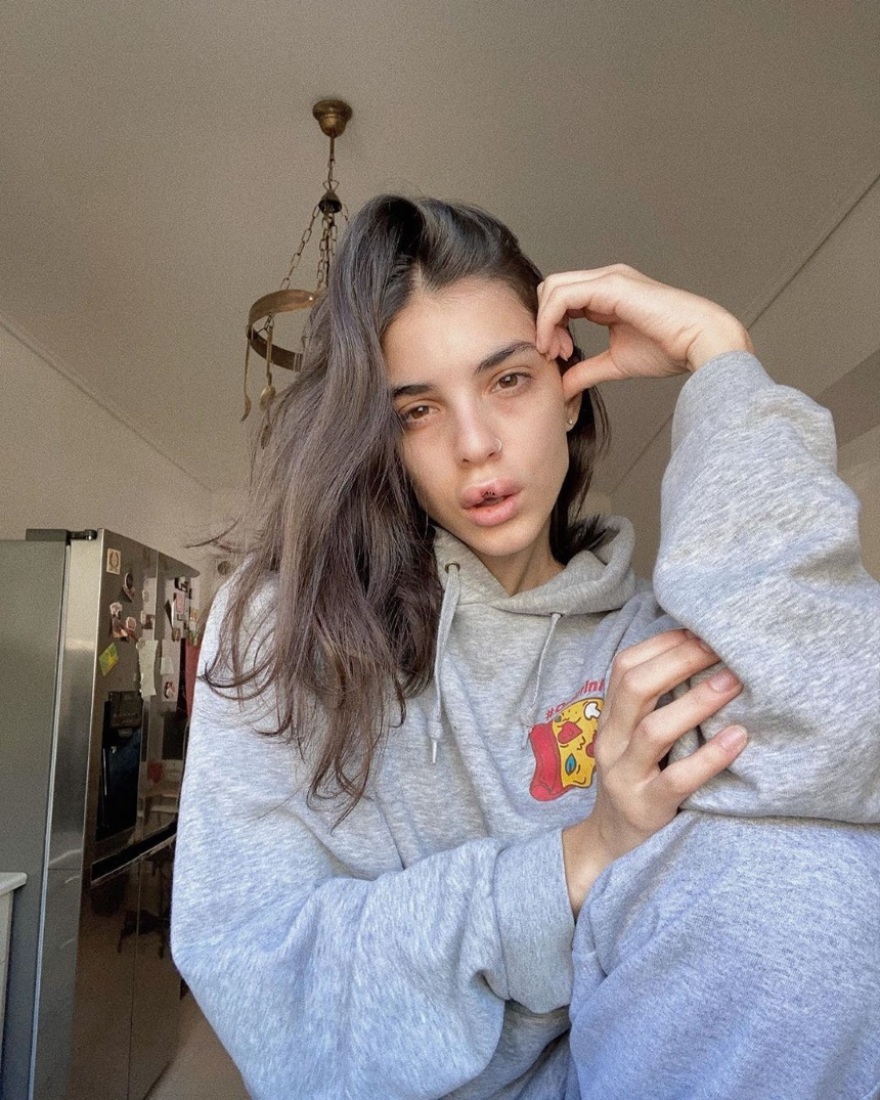 Ατύχημα για την Άννα Μαρία Βέλλη: Παραμορφώθηκαν τα χείλη της