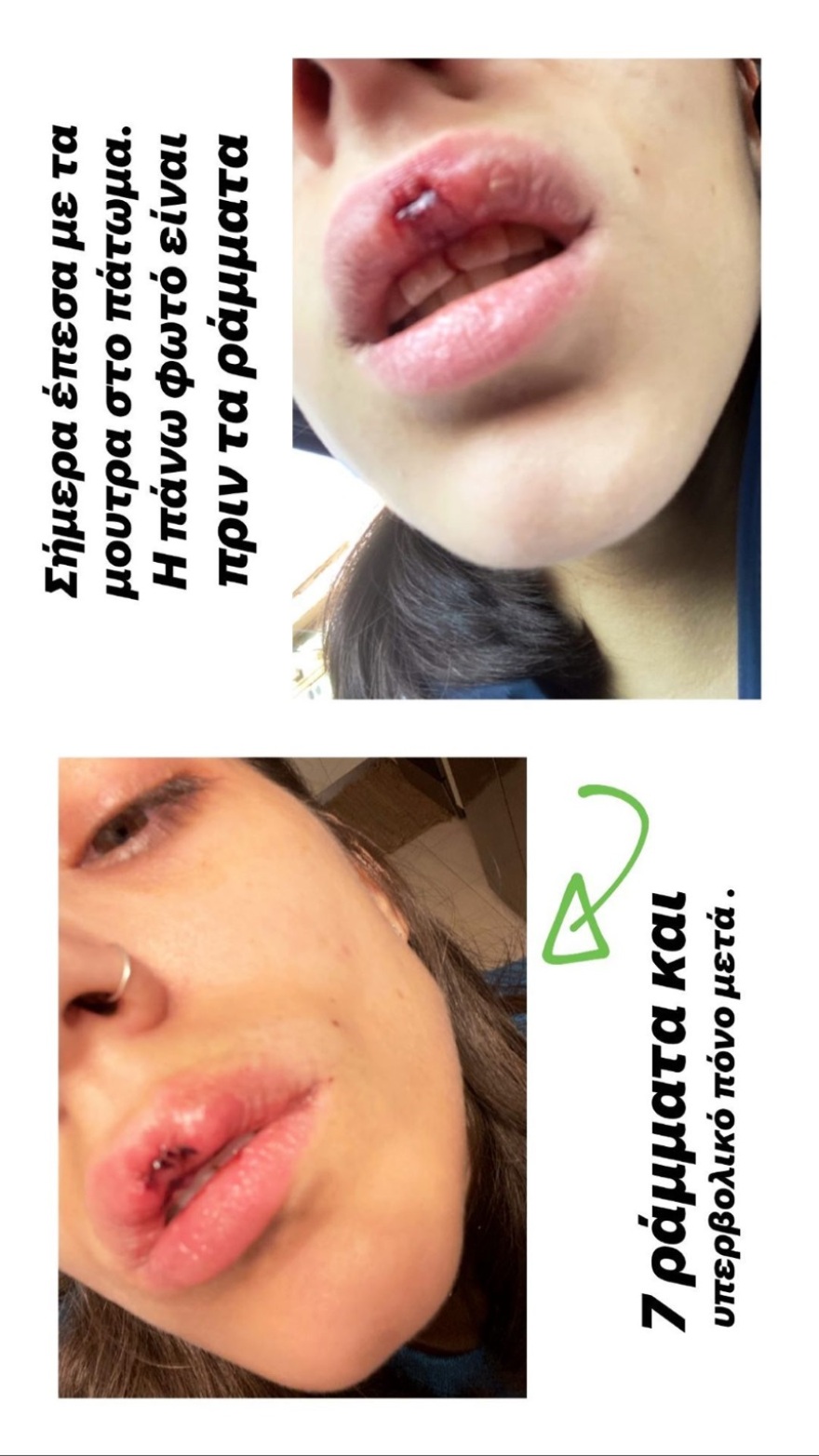 Ατύχημα για την Άννα Μαρία Βέλλη: Παραμορφώθηκαν τα χείλη της