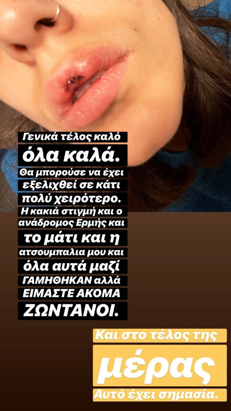 Ατύχημα για την Άννα Μαρία Βέλλη: Παραμορφώθηκαν τα χείλη της