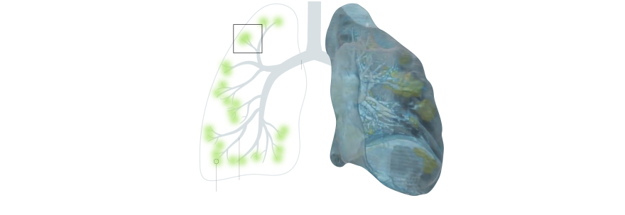 Κορωνοϊός: Δείτε βίντεο - Πώς «επιτίθεται» ο ιός στον οργανισμό μας