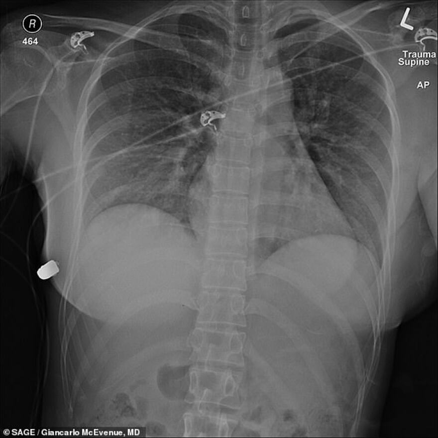 Γυναίκα από τον Καναδά γλίτωσε το θάνατο από σφαίρα χάρη στα... πλαστικά στήθη της