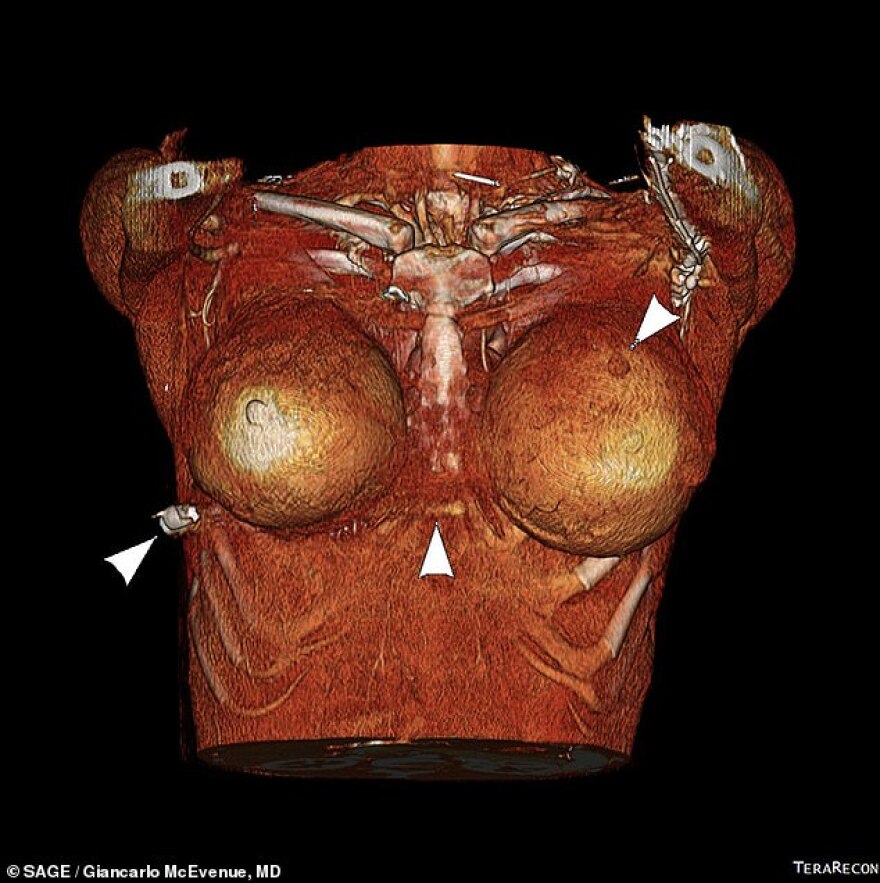 Γυναίκα από τον Καναδά γλίτωσε το θάνατο από σφαίρα χάρη στα... πλαστικά στήθη της
