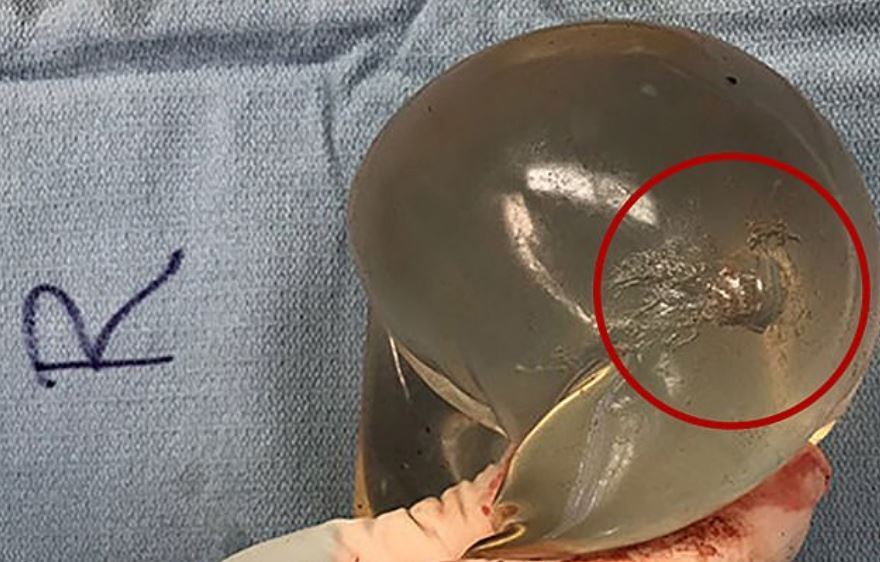 Γυναίκα από τον Καναδά γλίτωσε το θάνατο από σφαίρα χάρη στα... πλαστικά στήθη της