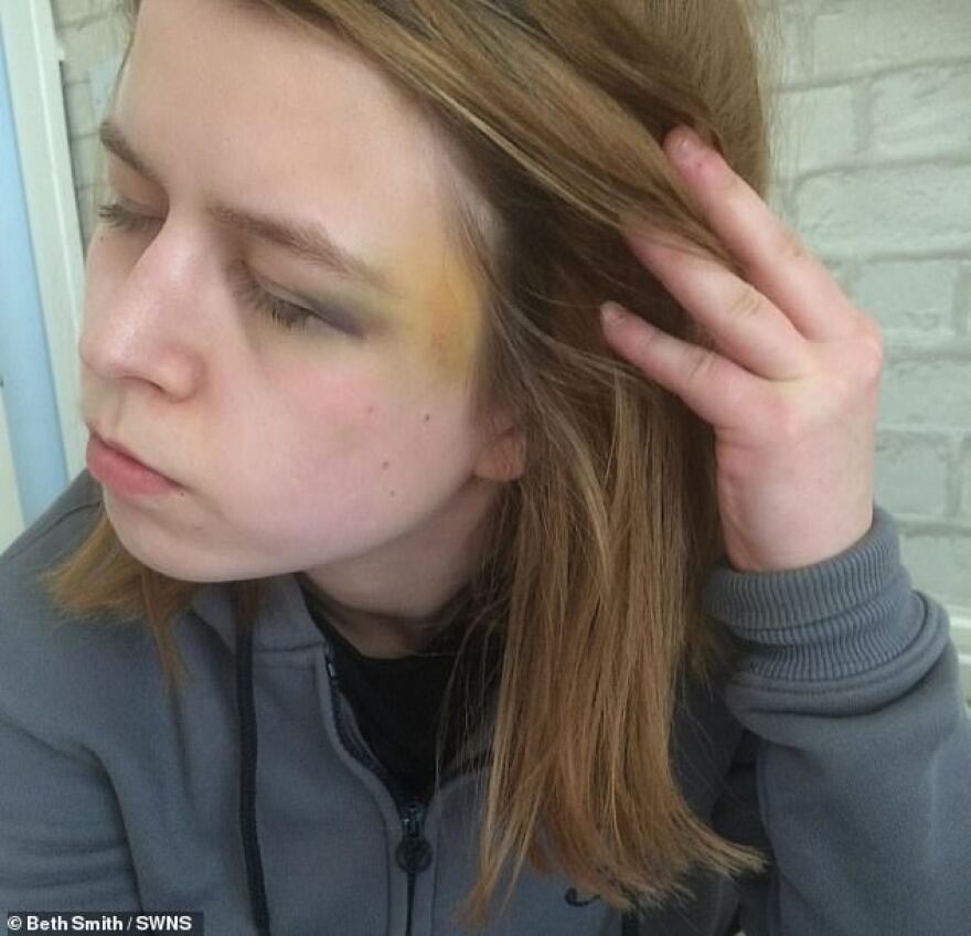 Vegan ξυλοκόπησε τη φίλη του με μπουκάλι ξύδι γιατί... μύριζε μπέικον!