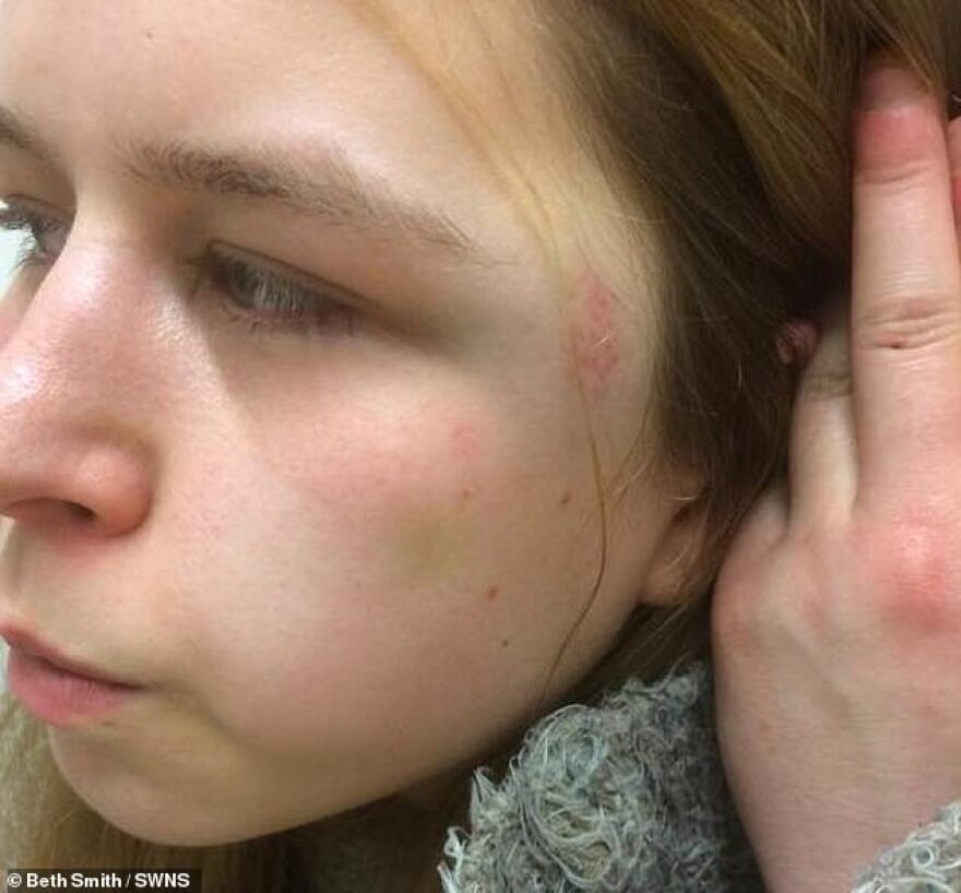 Vegan ξυλοκόπησε τη φίλη του με μπουκάλι ξύδι γιατί... μύριζε μπέικον!