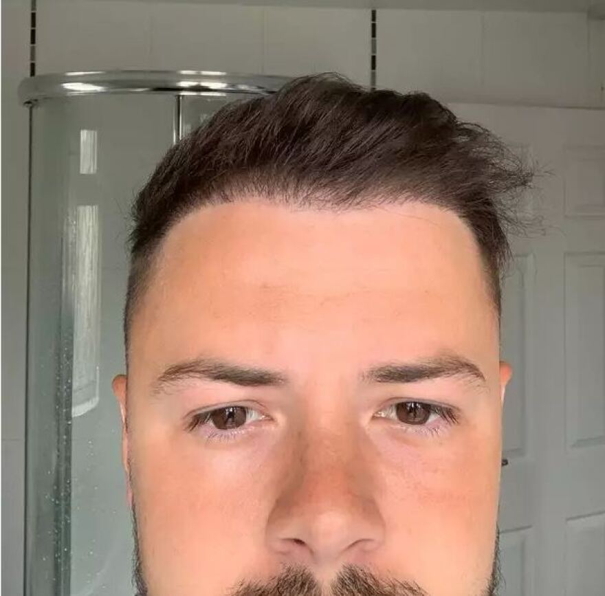 Τουρκία: Έδωσε πάνω από 1.000 λίρες για μεταμόσχευση μαλλιών και έφυγε χωρίς... μαλλιά