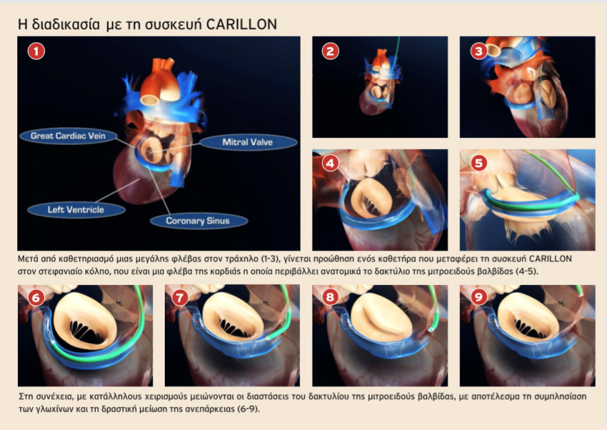 Metropolitan Hospital: πρωτοποριακή, διαδερμική μέθοδος για την επιδιόρθωση ανεπάρκειας της μιτροειδούς βαλβίδας
