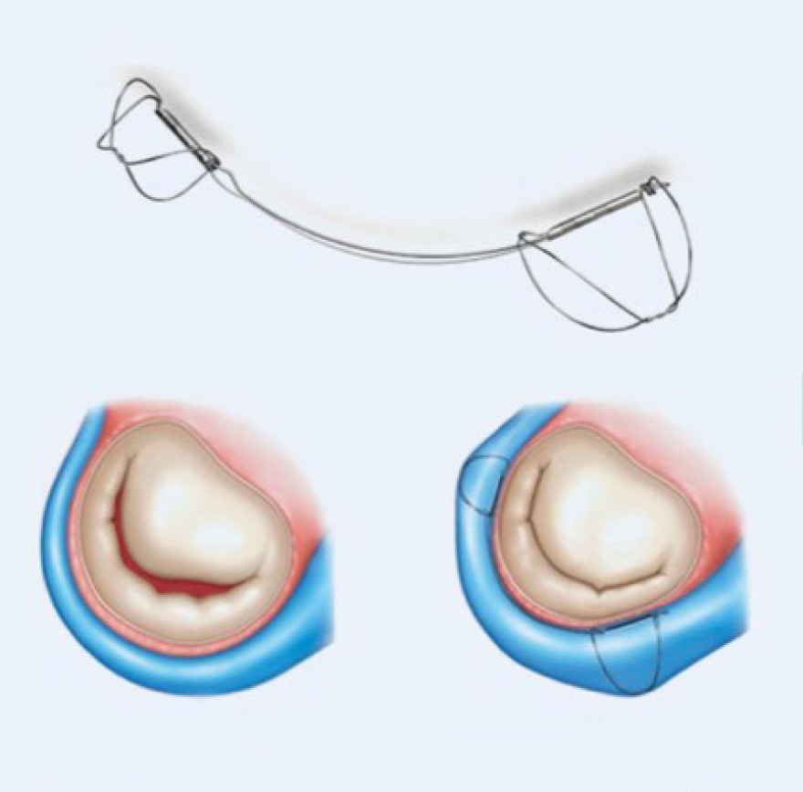 Metropolitan Hospital: πρωτοποριακή, διαδερμική μέθοδος για την επιδιόρθωση ανεπάρκειας της μιτροειδούς βαλβίδας