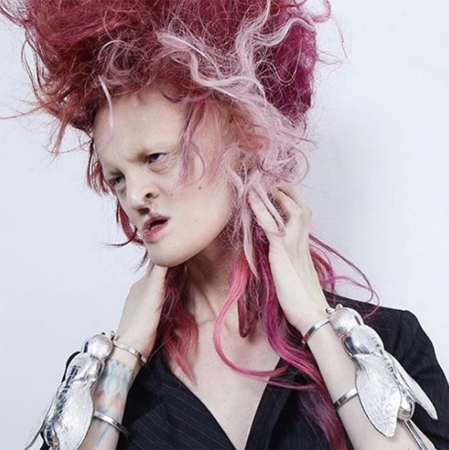 Μέλανι Γκέιντος: Το «τέρας» με τη σπάνια νόσο που έγινε τοπ μόντελ