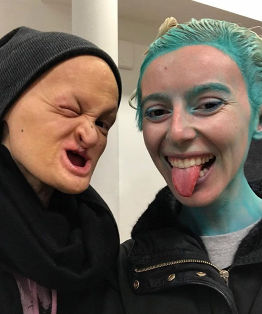 Μέλανι Γκέιντος: Το «τέρας» με τη σπάνια νόσο που έγινε τοπ μόντελ