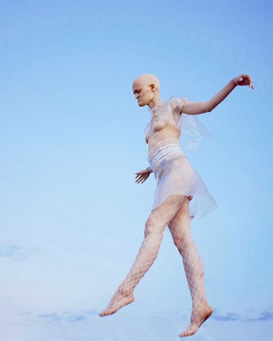 Μέλανι Γκέιντος: Το «τέρας» με τη σπάνια νόσο που έγινε τοπ μόντελ