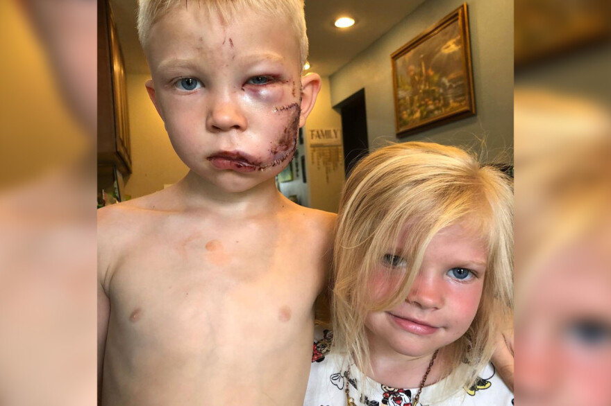 ΗΠΑ: Εξάχρονος έγινε φύλακας - άγγελος της αδερφής του όταν της επιτέθηκε σκύλος