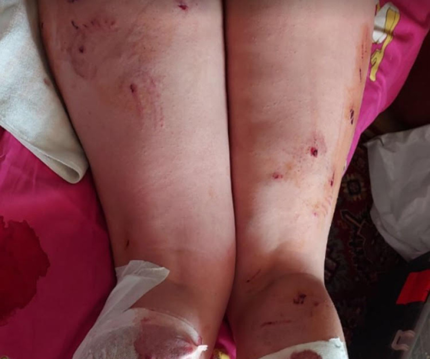 Συγκλονίζει η μητέρα της 17χρονης που δέχθηκε επίθεση από σκύλους: Σε άθλια κατάσταση το παιδί μου, είχε παραισθήσεις