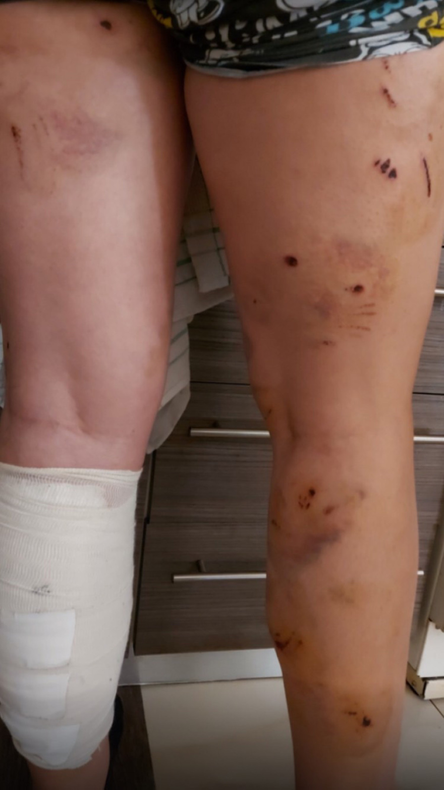 Συγκλονίζει η μητέρα της 17χρονης που δέχθηκε επίθεση από σκύλους: Σε άθλια κατάσταση το παιδί μου, είχε παραισθήσεις