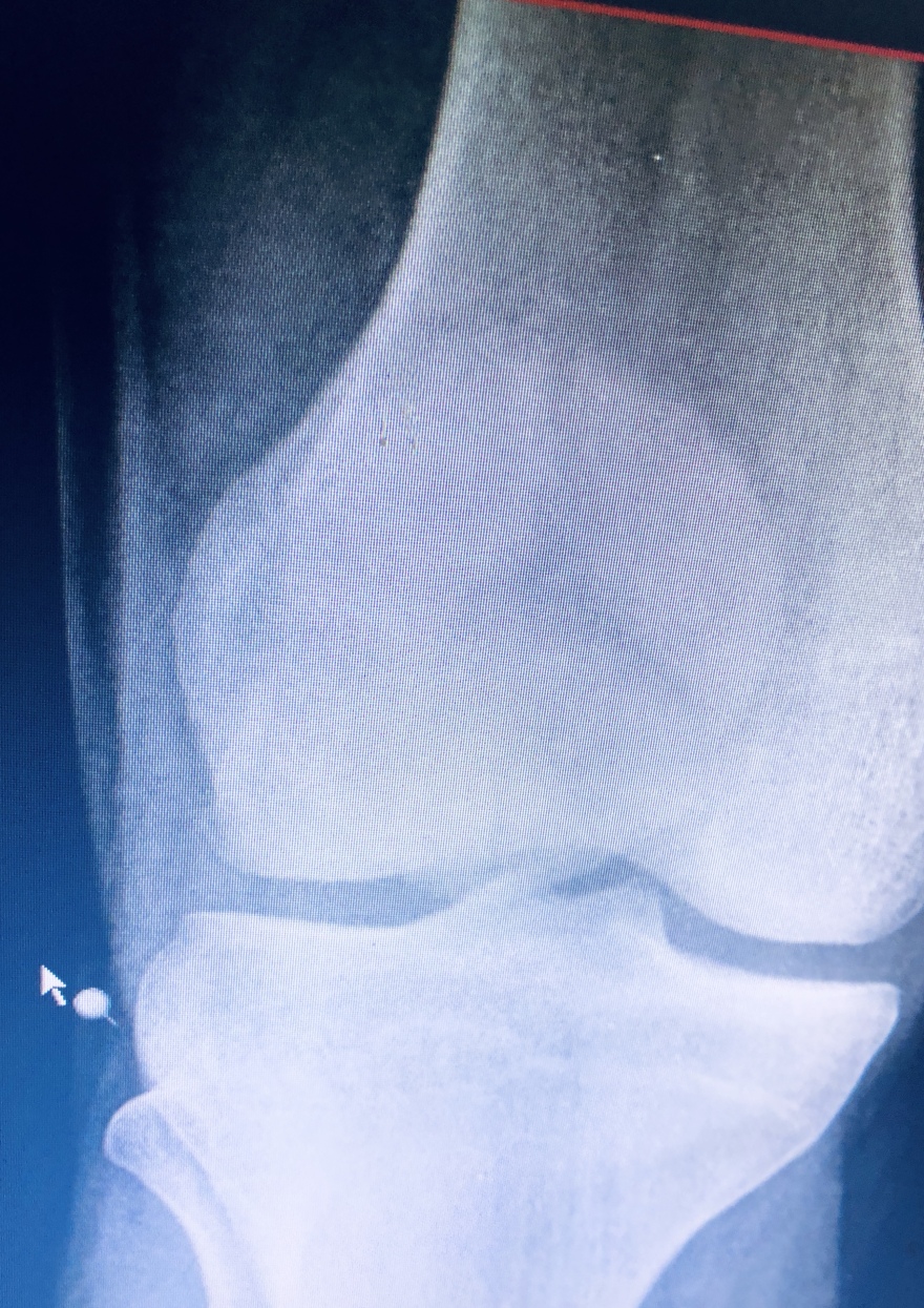 Τζάνειο νοσοκομείο: Νέα μέθοδος για την αντιμετώπιση συντριπτικών καταγμάτων της επιγονατίδας