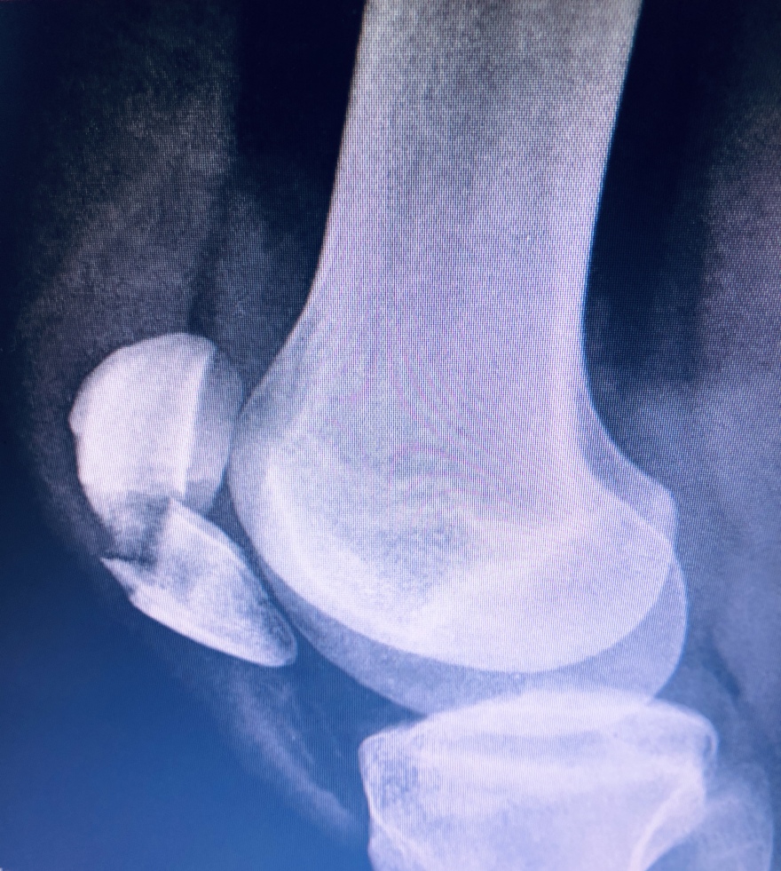 Τζάνειο νοσοκομείο: Νέα μέθοδος για την αντιμετώπιση συντριπτικών καταγμάτων της επιγονατίδας