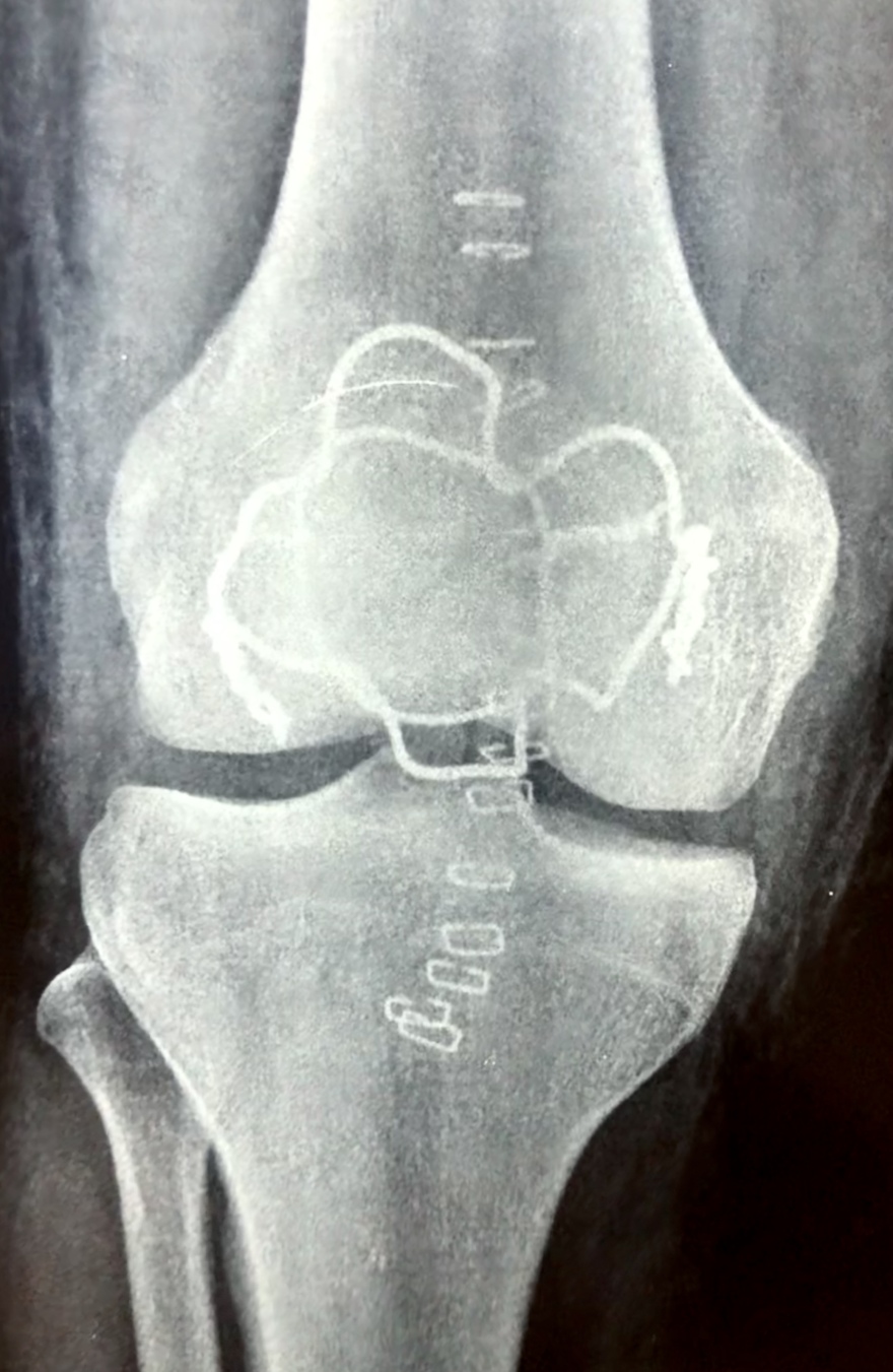 Τζάνειο νοσοκομείο: Νέα μέθοδος για την αντιμετώπιση συντριπτικών καταγμάτων της επιγονατίδας