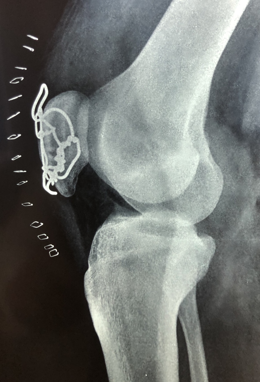 Τζάνειο νοσοκομείο: Νέα μέθοδος για την αντιμετώπιση συντριπτικών καταγμάτων της επιγονατίδας