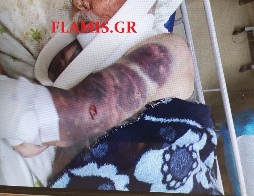 Θρασύτατη ληστεία στην Πάτρα: Άγριο ξύλο σε ηλικιωμένο για να του πάρουν μερικά ευρώ! (φωτογραφίες)