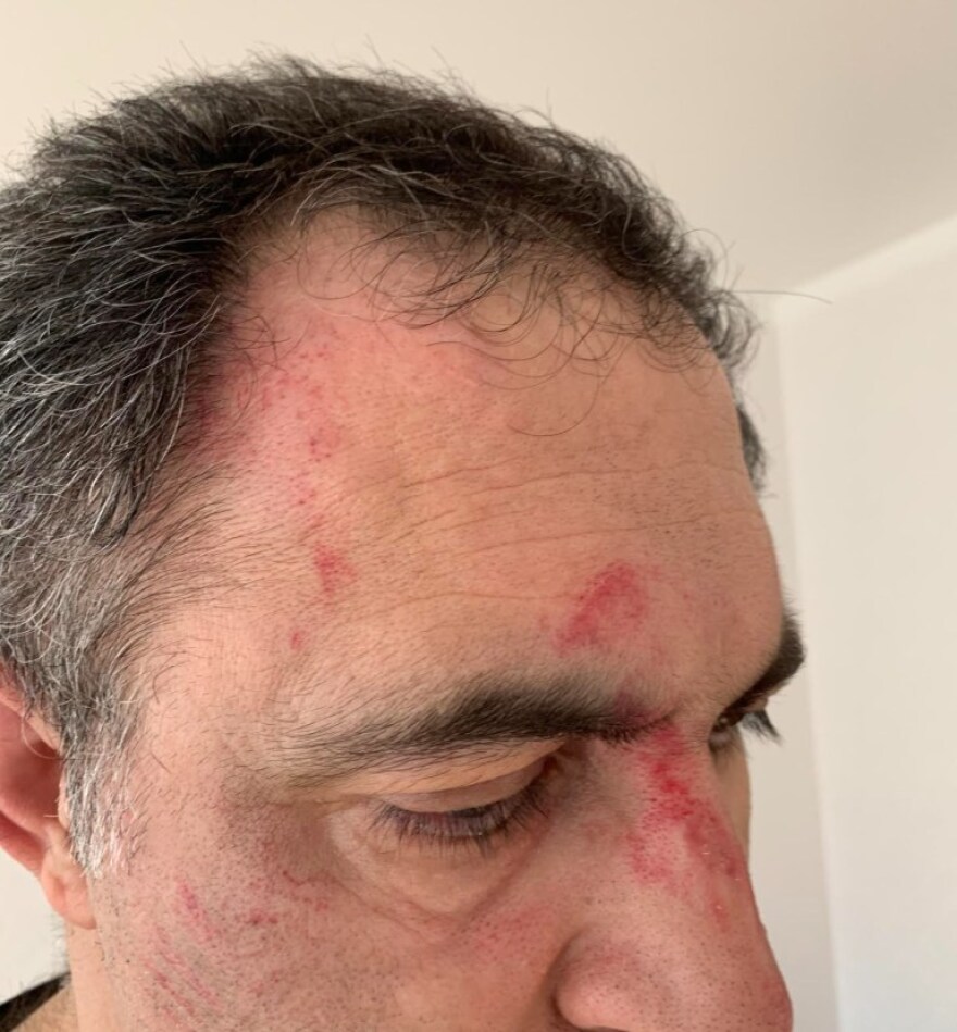 Επίθεση δέχτηκε ο αυτοεξόριστος Τούρκος δημοσιογράφος – επικριτής του Ερντογάν