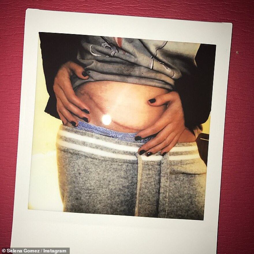 Η Σελένα Γκόμεζ μας δείχνει περήφανα την ουλή στο σώμα της από τη μεταμόσχευση νεφρού 