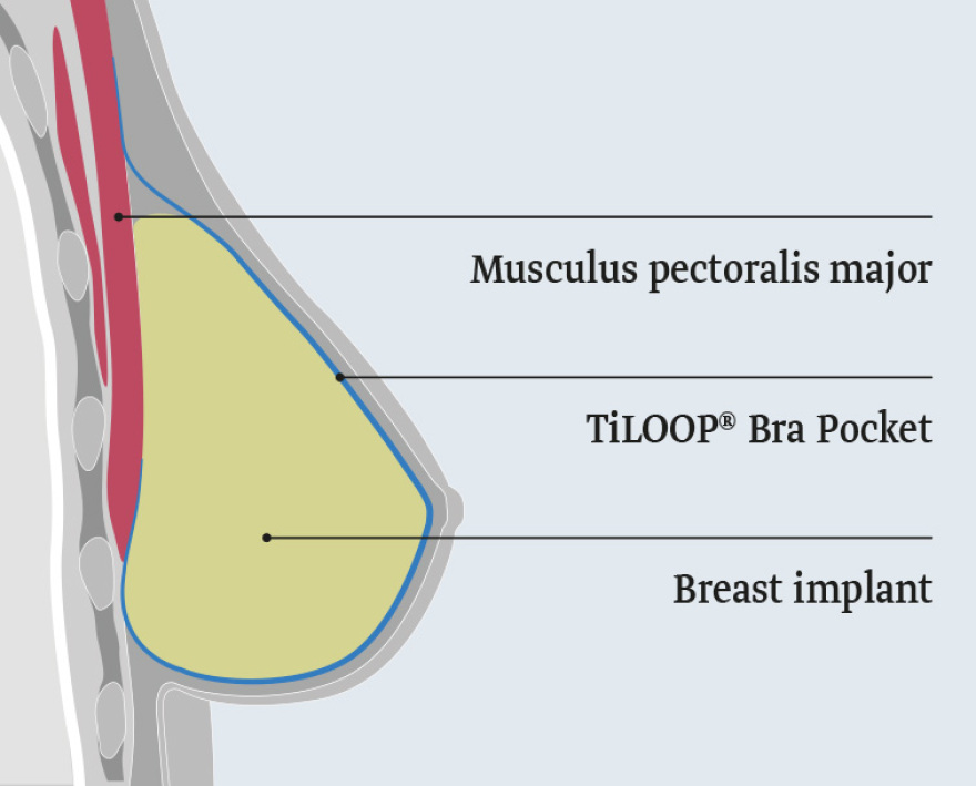 Νέα μέθοδος αποκατάστασης από μαστεκτομή - «Παραμονεύει στις ζωές μας ο καρκίνος» τονίζει η Νατάσα Παζαΐτη 