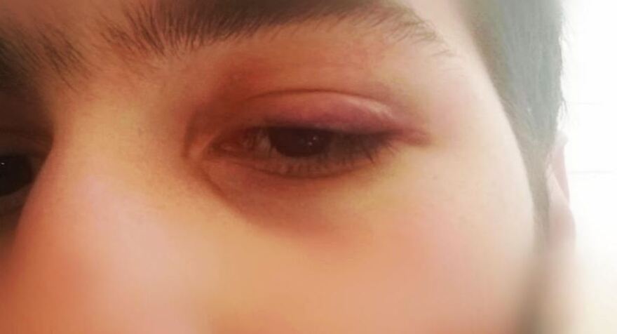 Φοιτητής καταγγέλλει ξυλοδαρμό από μπράβους επειδή διαμαρτυρήθηκε για τον συνωστισμό