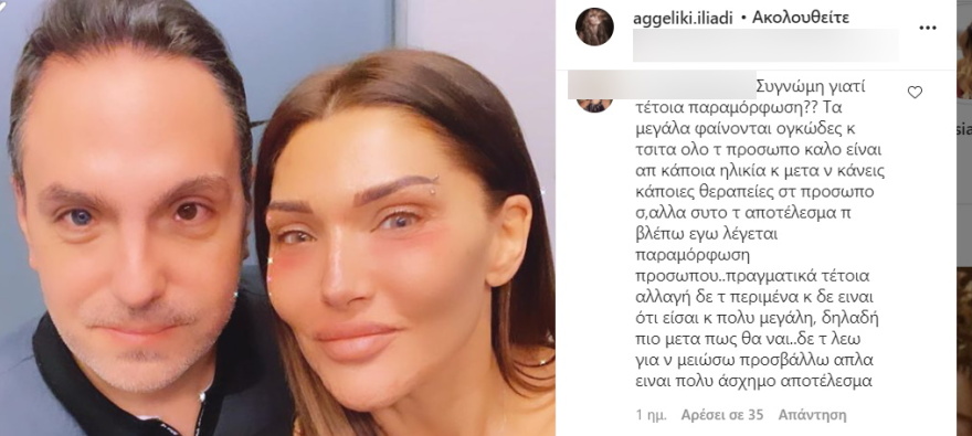 Αγγελική Ηλιάδη: Η αφοπλιστική απάντηση σε follower που της είπε ότι παραμορφώθηκε 