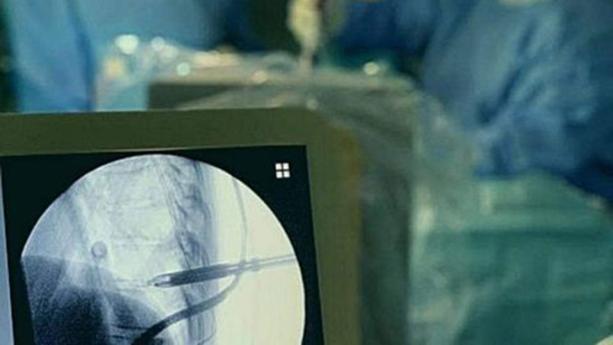 Για πρώτη φορά απόλυτα επιτυχημένη διαδερμική ενδοσκοπική δισκεκτομή