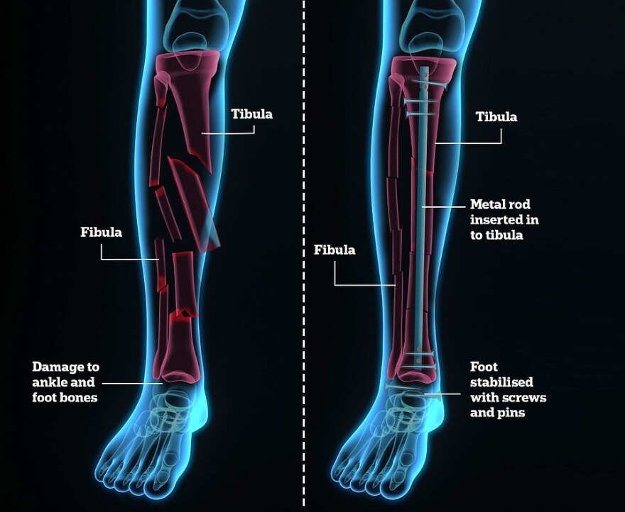 Τάιγκερ Γουντς: Γιατί οι γιατροί φοβούνται ότι μπορεί να μην ξαναπαίξει γκολφ