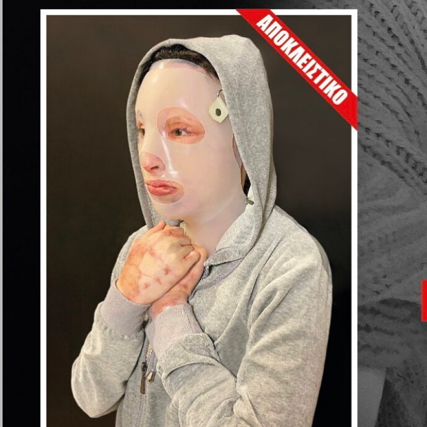 Ιωάννα Παλιοσπύρου: Η πρώτη φωτογραφία μετά την επίθεση με βιτριόλι