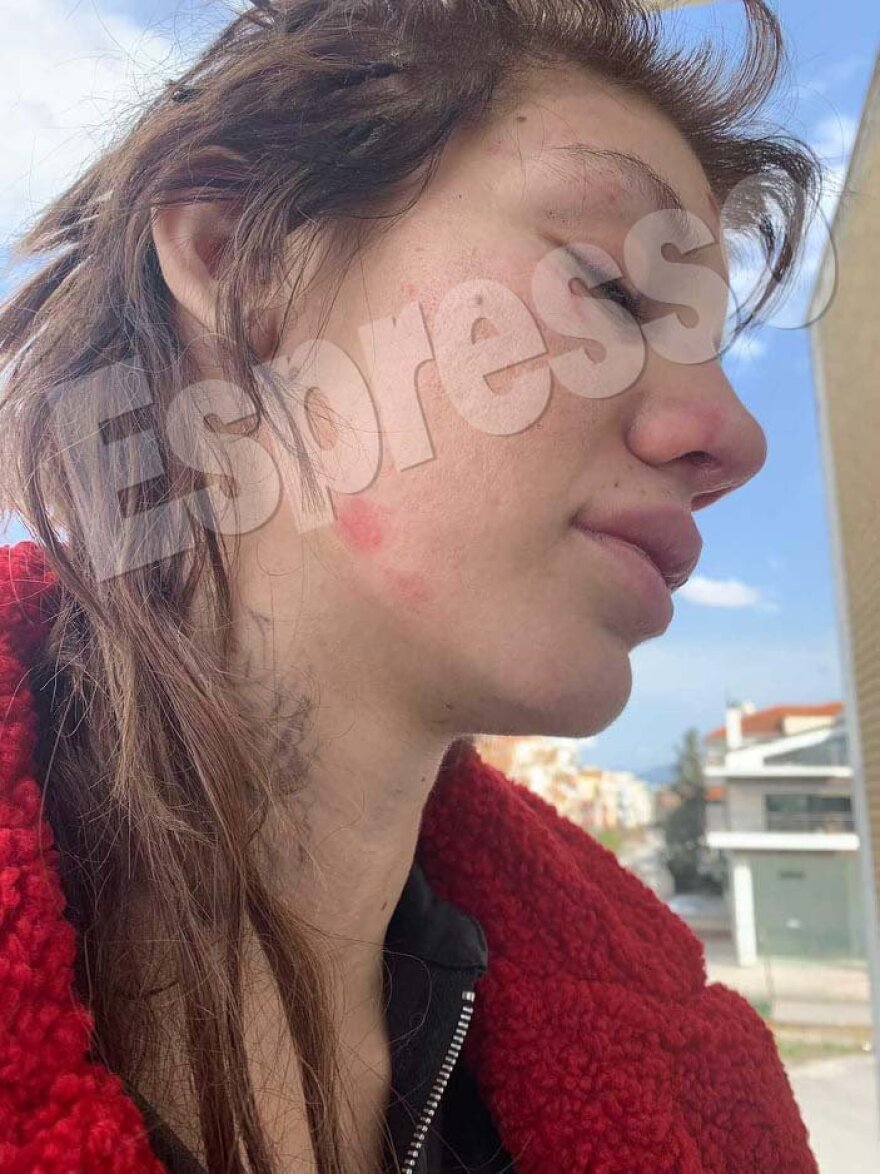 Εφιάλτης για τη Μαρία Αλεξάνδρου: Έξι γυναίκες την απήγαγαν, την χτύπησαν και την κούρεψαν - Φωτογραφίες σοκ