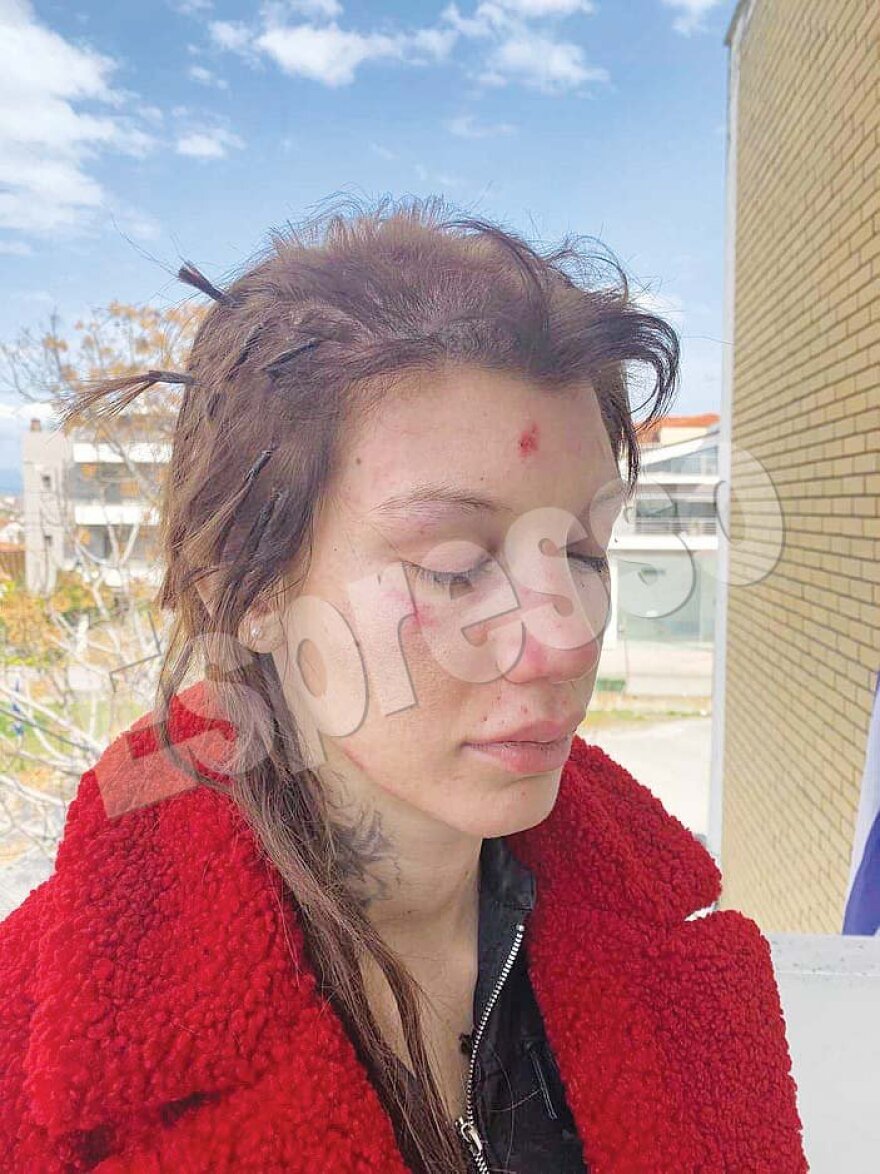 Εφιάλτης για τη Μαρία Αλεξάνδρου: Έξι γυναίκες την απήγαγαν, την χτύπησαν και την κούρεψαν - Φωτογραφίες σοκ