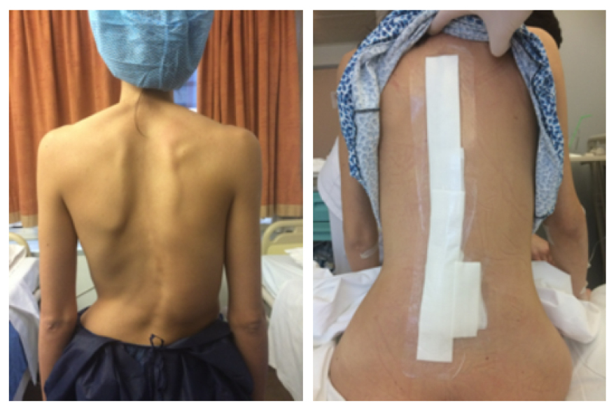 Χειρουργική αντιμετώπιση σκολίωσης και κύφωσης με το ρομποτικό σύστημα ExcelsiusGPS