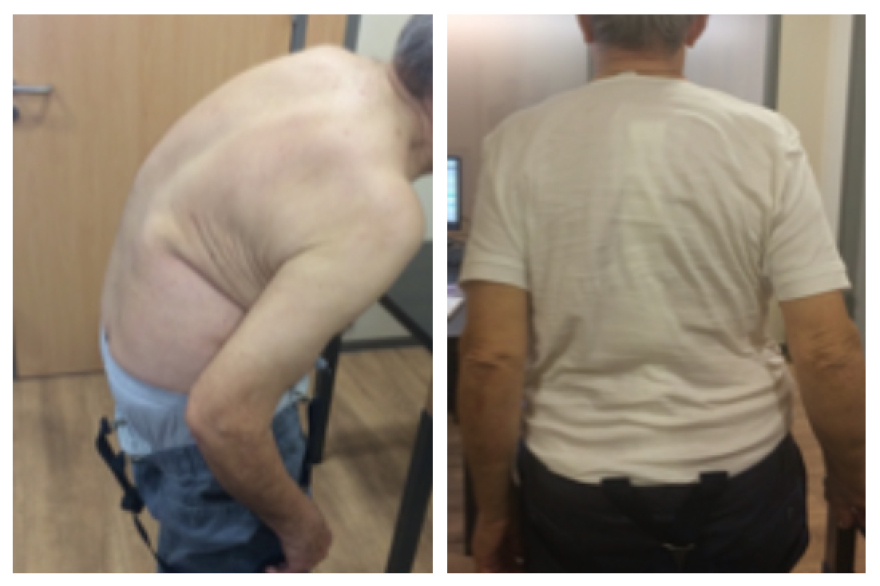 Χειρουργική αντιμετώπιση σκολίωσης και κύφωσης με το ρομποτικό σύστημα ExcelsiusGPS