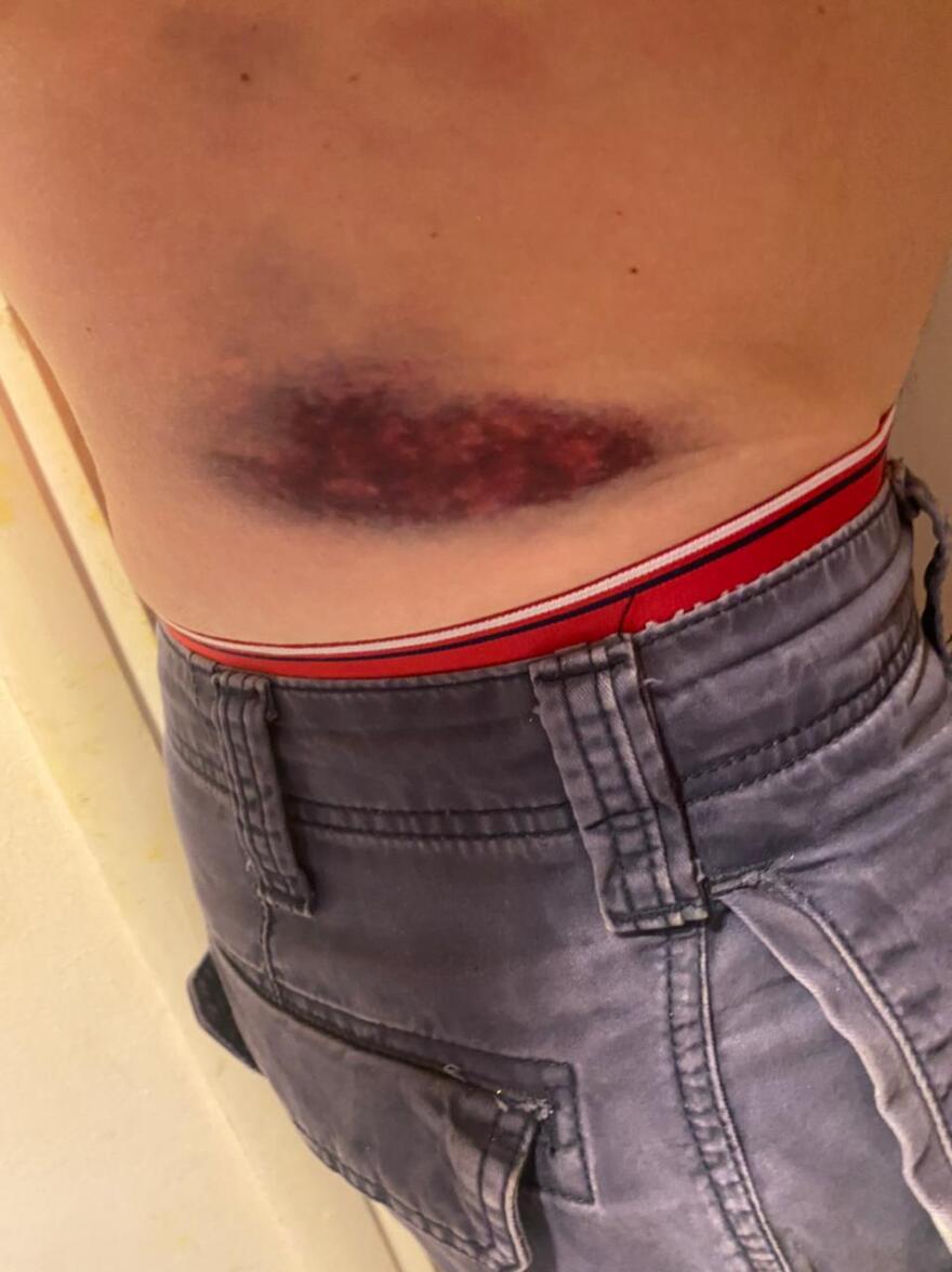 Μετς: Πατέρας και γιος έβαλαν ροτβάιλερ να επιτεθεί σε 30χρονο - Φωτογραφίες