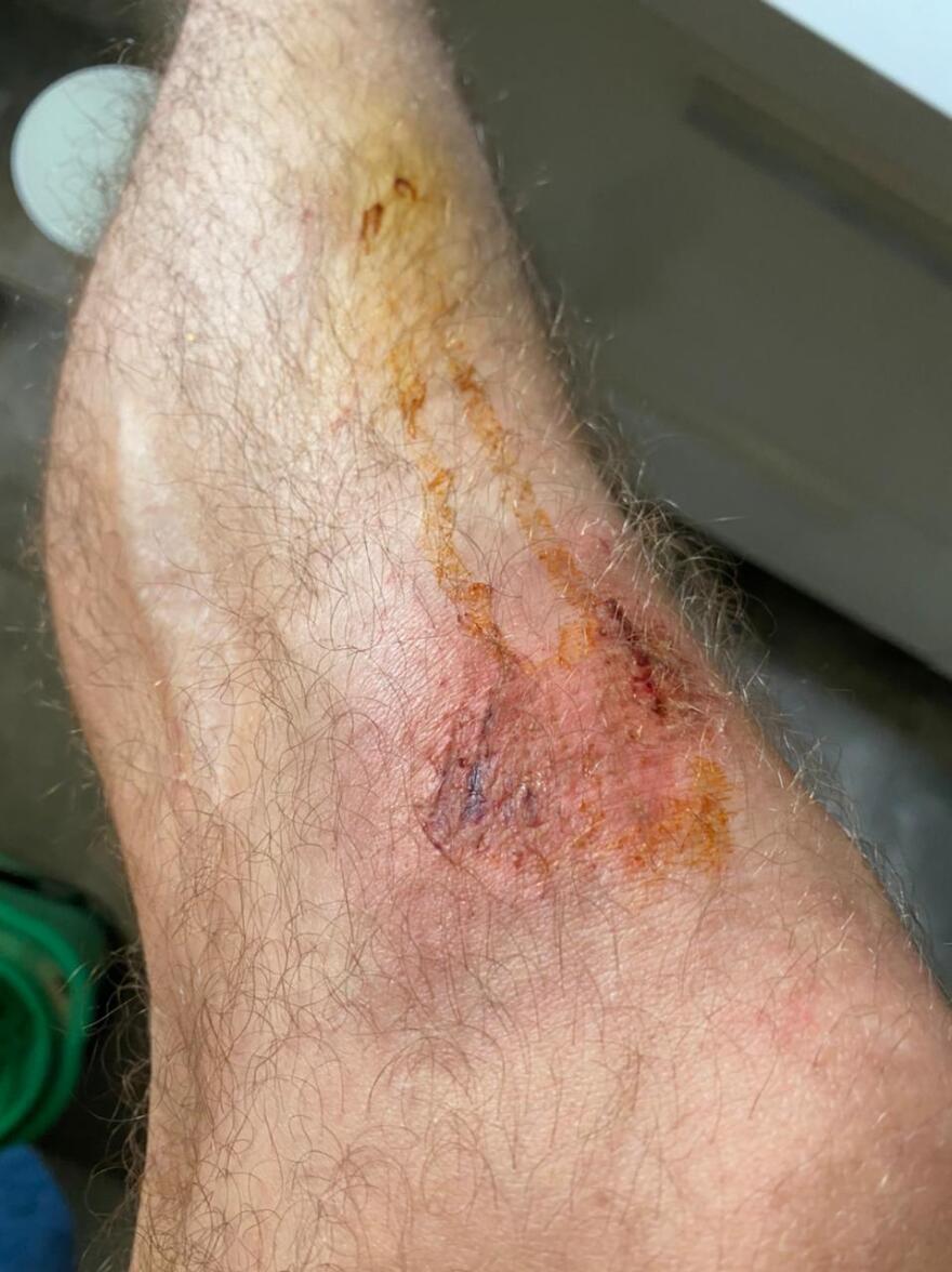 Μετς: Πατέρας και γιος έβαλαν ροτβάιλερ να επιτεθεί σε 30χρονο - Φωτογραφίες